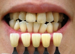 ホワイトニング前の歯の色調を確認します。