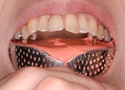 ホワイトニング効果を高めるために歯面のクリーニングを行います。
